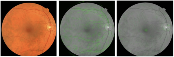 google-retinal-fundus-images-cv-risk-prediction.pn