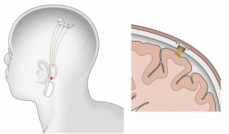 neuralink 2